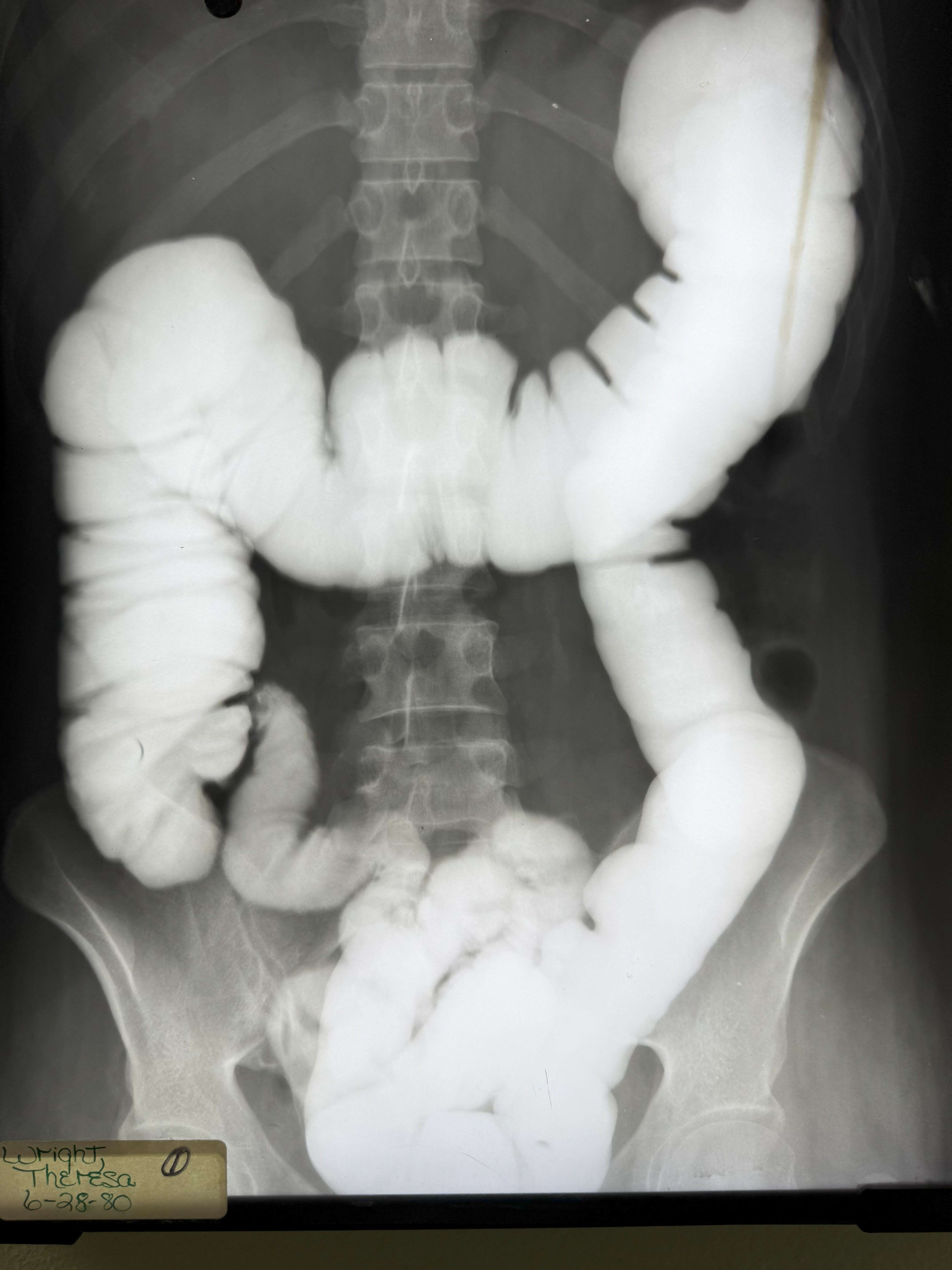 Theresa's X Rays