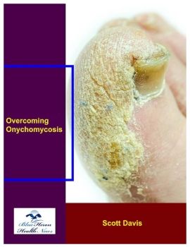 Overcoming Onychomycosis™ PDF eBook Scott Davis
