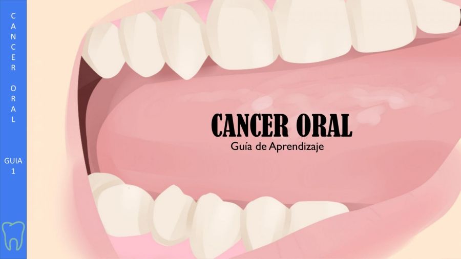 CANCER ORAL- odontologia sinu