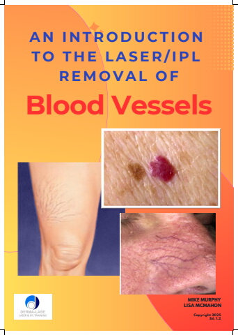 The removal of blood vessels