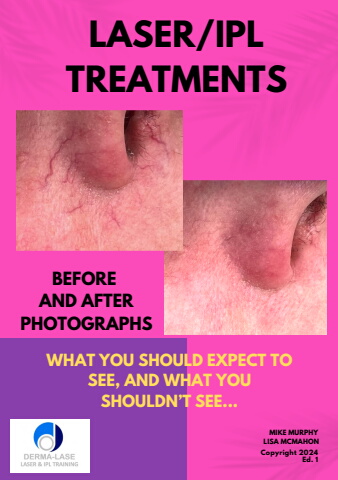 Laser-IPL Treatments - Before and After photos