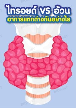 ไทรอยด์ VS อ้วน อาการแตกต่างกันอย่างไร